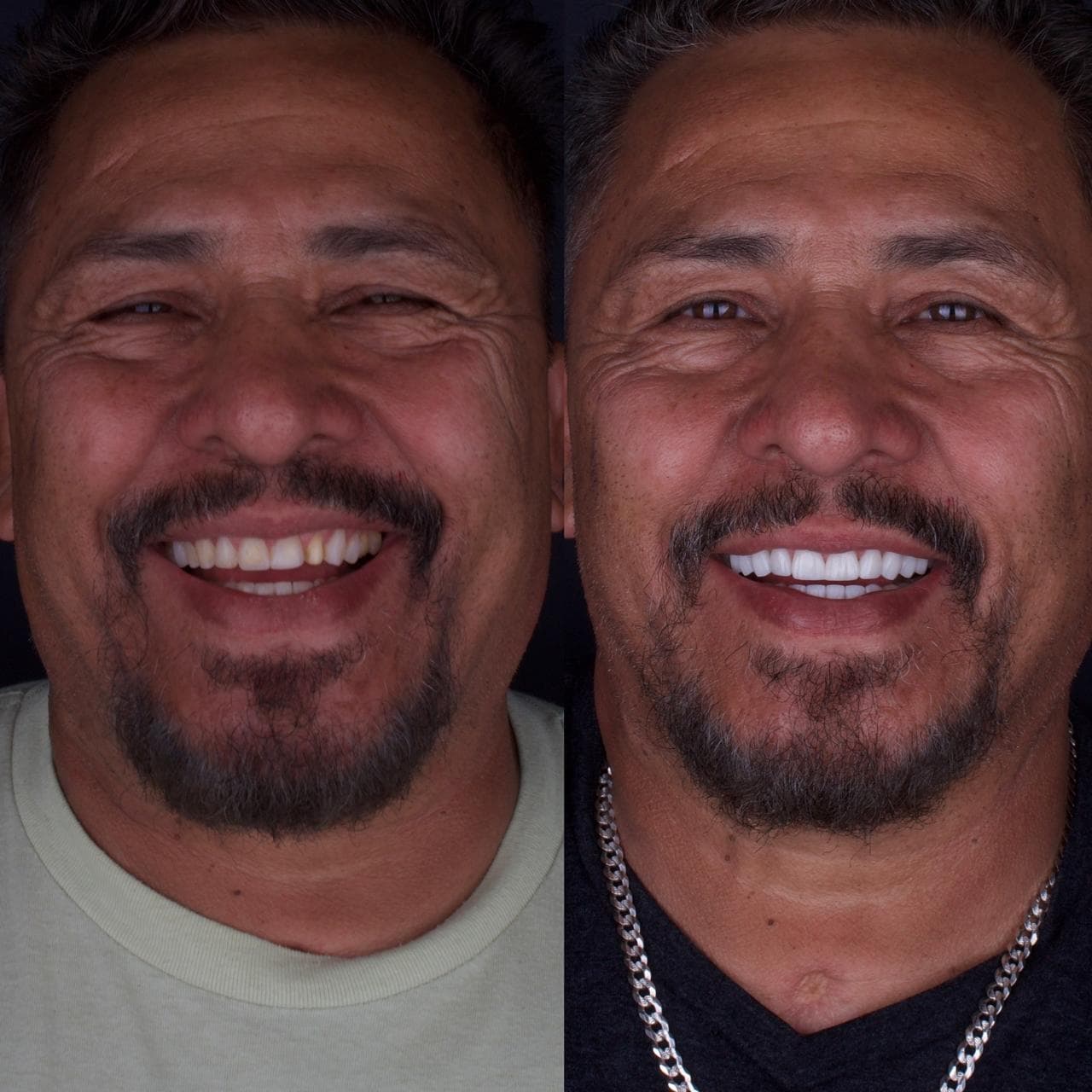 Resultado de diseño de sonrisa en paciente