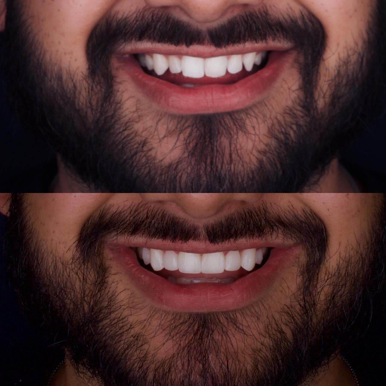 Detalle antes y después de carillas dentales